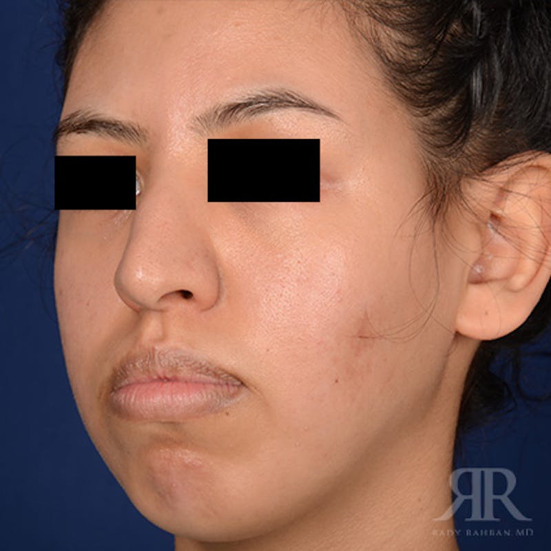 Female Rhinoplasty Before & After Gallery - Patient 179638 - Image 3