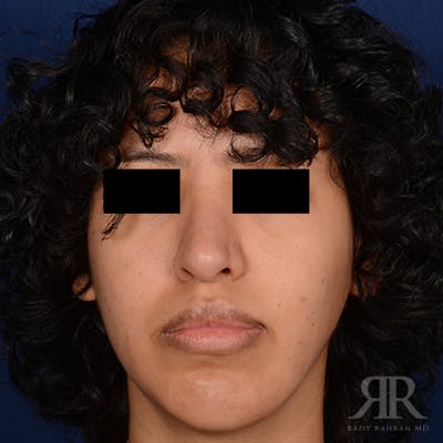Female Rhinoplasty Before & After Gallery - Patient 179638 - Image 2