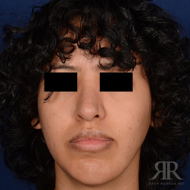 Female Rhinoplasty Before & After Gallery - Patient 179638 - Image 2