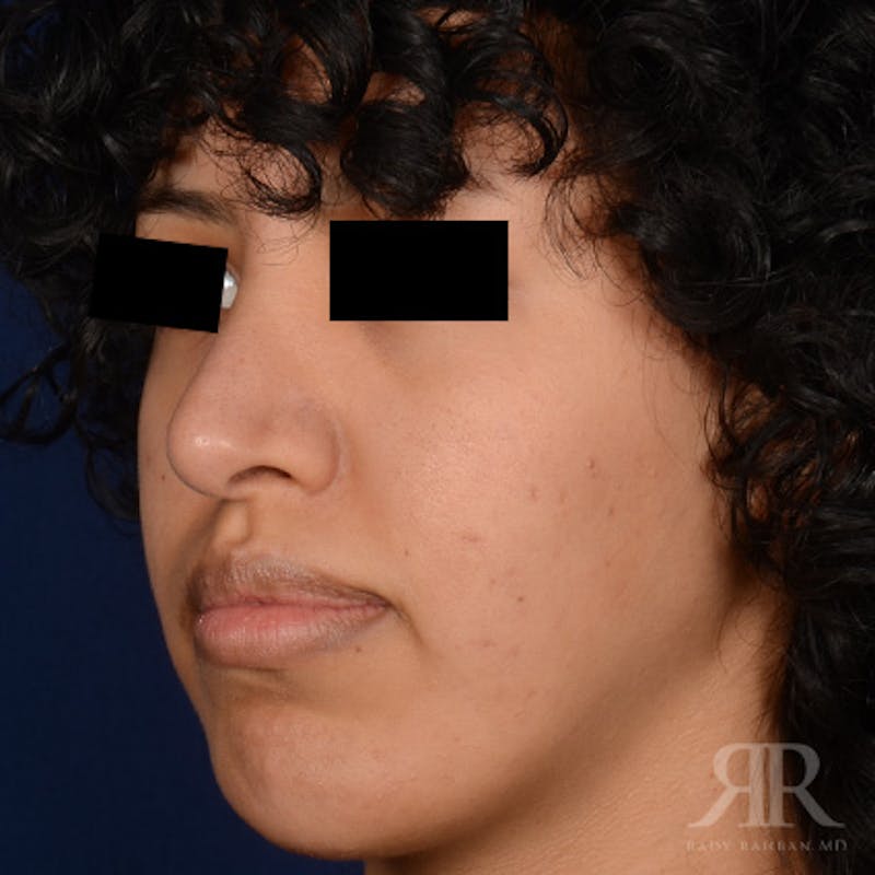 Female Rhinoplasty Before & After Gallery - Patient 179638 - Image 4