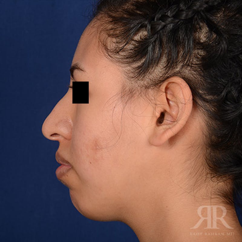 Female Rhinoplasty Before & After Gallery - Patient 179638 - Image 5