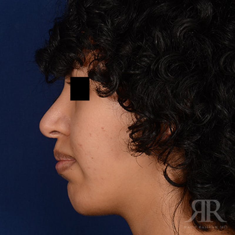 Female Rhinoplasty Before & After Gallery - Patient 179638 - Image 6