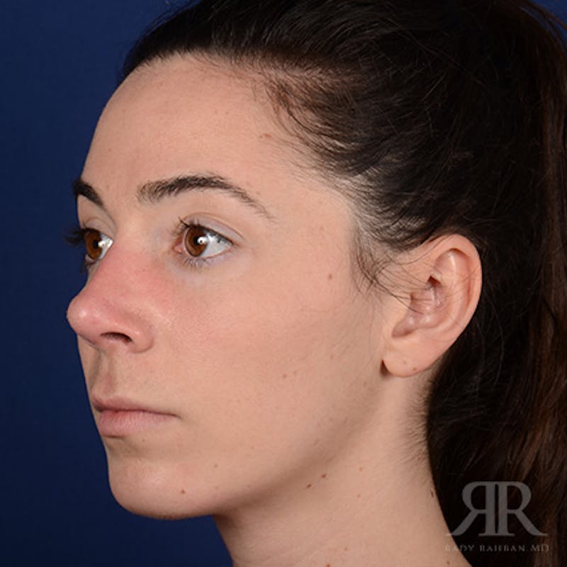 Female Rhinoplasty Before & After Gallery - Patient 418919 - Image 4