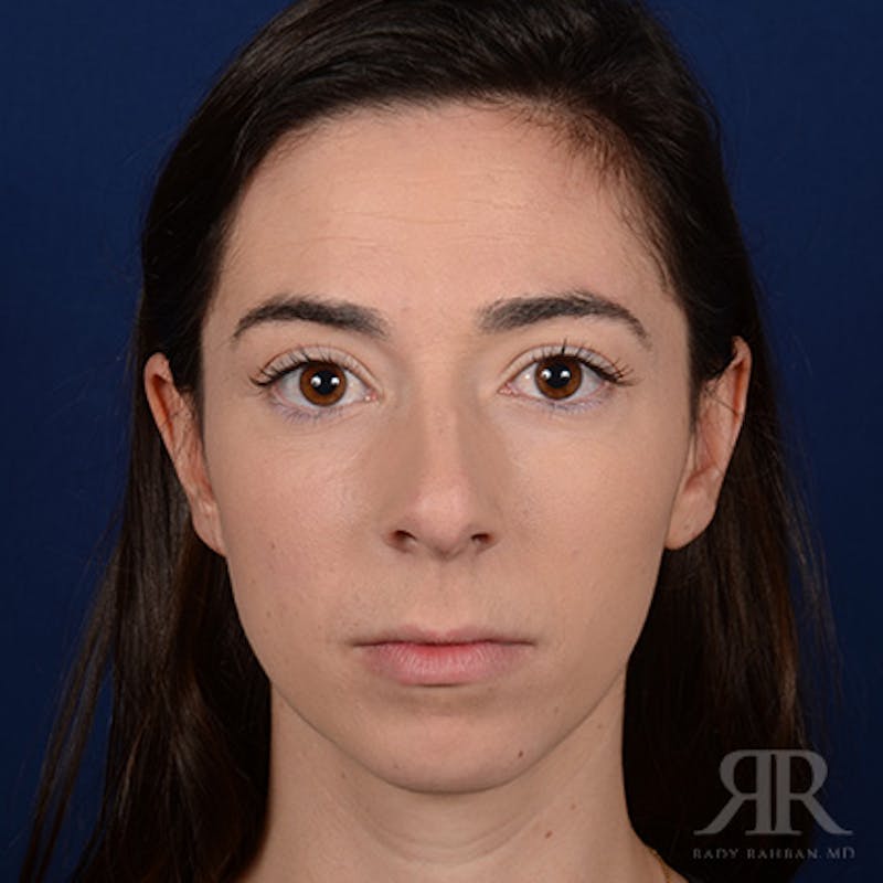 Female Rhinoplasty Before & After Gallery - Patient 418919 - Image 1