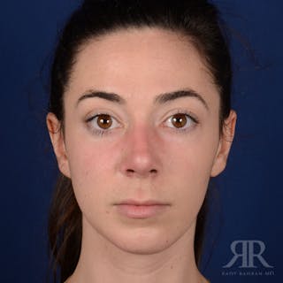 Female Rhinoplasty Before & After Gallery - Patient 418919 - Image 2