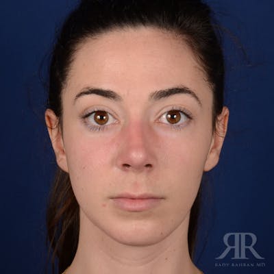 Female Rhinoplasty Before & After Gallery - Patient 418919 - Image 2