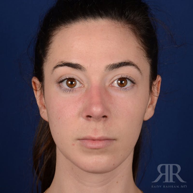 Female Rhinoplasty Before & After Gallery - Patient 418919 - Image 2