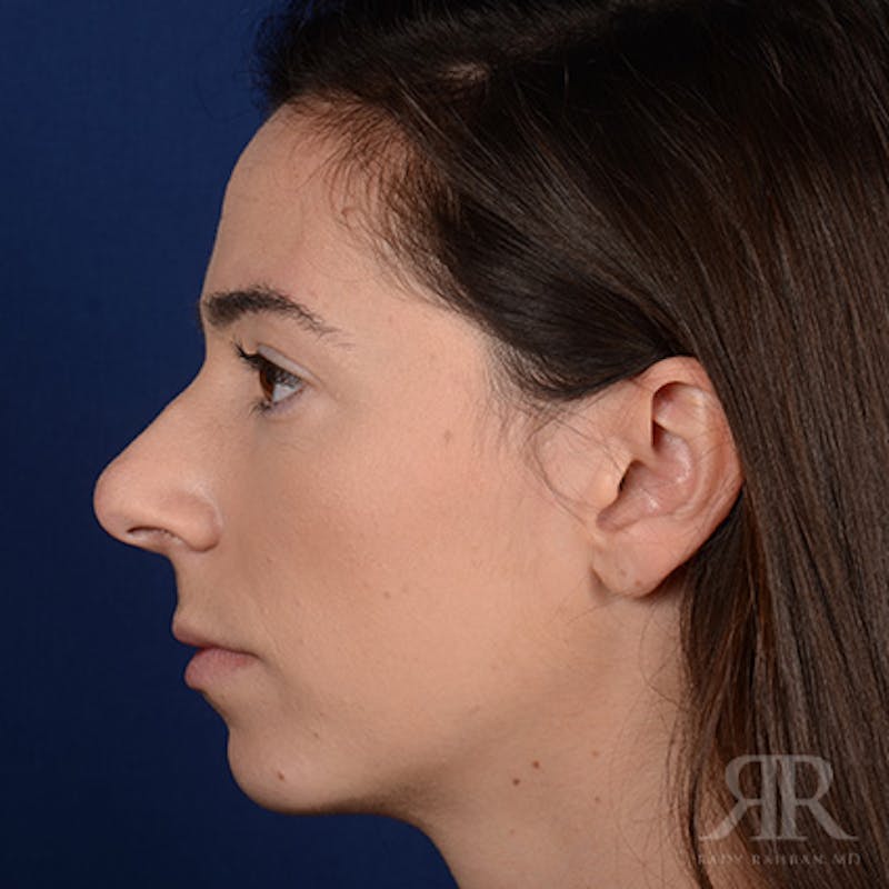 Female Rhinoplasty Before & After Gallery - Patient 418919 - Image 5