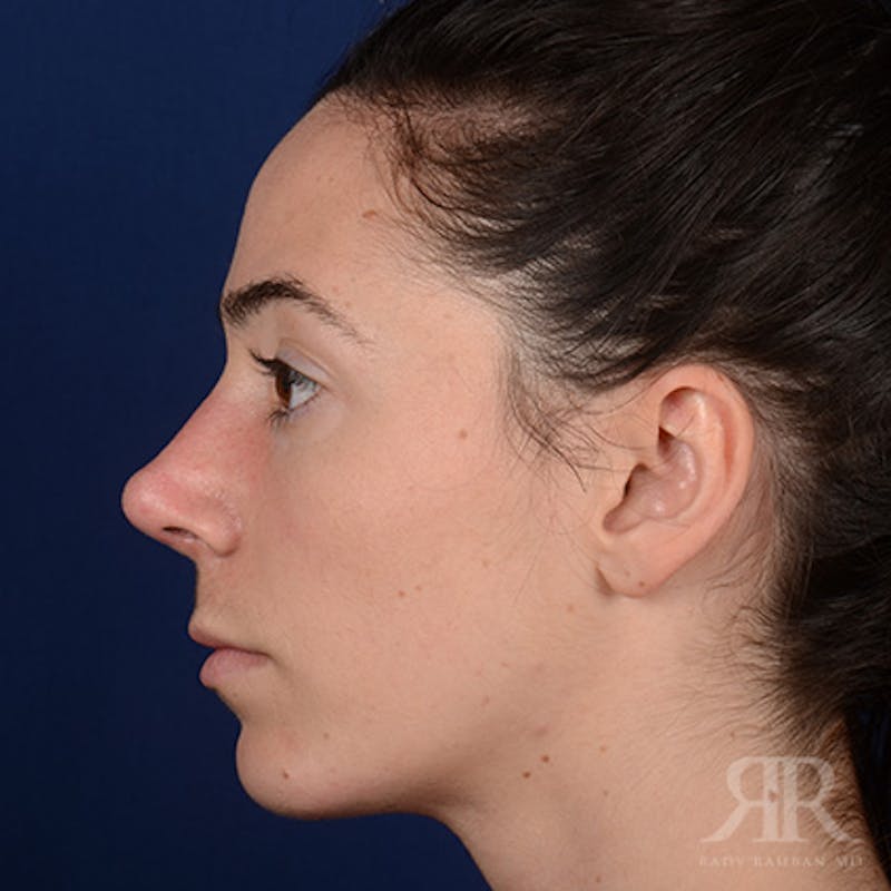 Female Rhinoplasty Before & After Gallery - Patient 418919 - Image 6