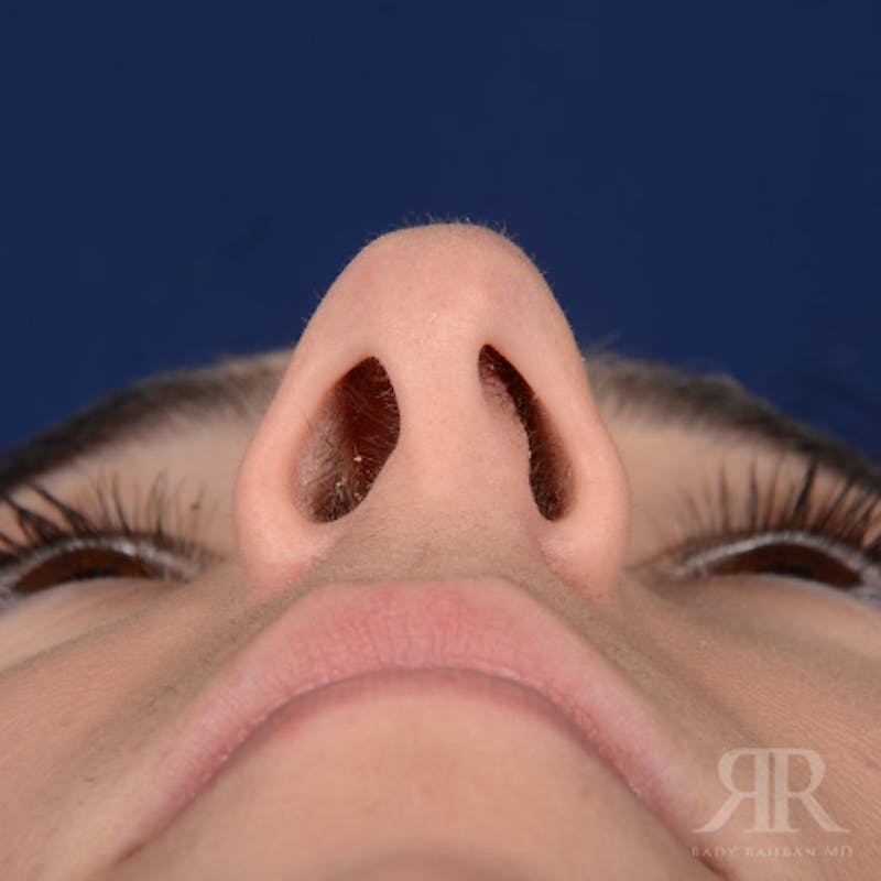 Female Rhinoplasty Before & After Gallery - Patient 418919 - Image 7