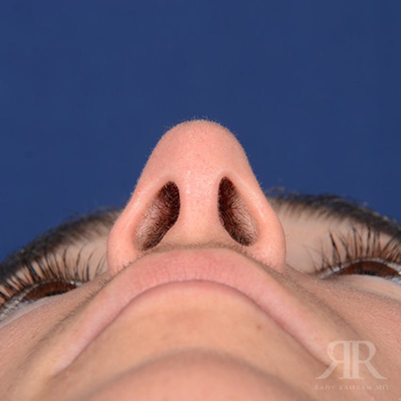 Female Rhinoplasty Before & After Gallery - Patient 418919 - Image 8