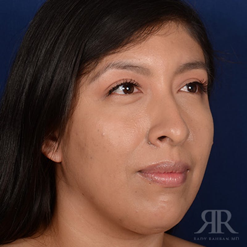 Female Rhinoplasty Before & After Gallery - Patient 419825 - Image 3