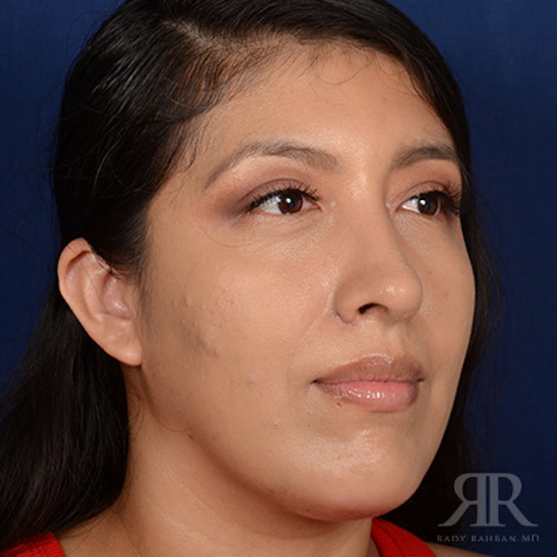 Female Rhinoplasty Before & After Gallery - Patient 419825 - Image 4