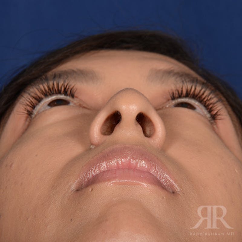 Female Rhinoplasty Before & After Gallery - Patient 419825 - Image 7