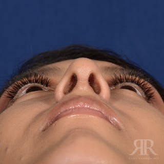 Female Rhinoplasty Before & After Gallery - Patient 419825 - Image 8