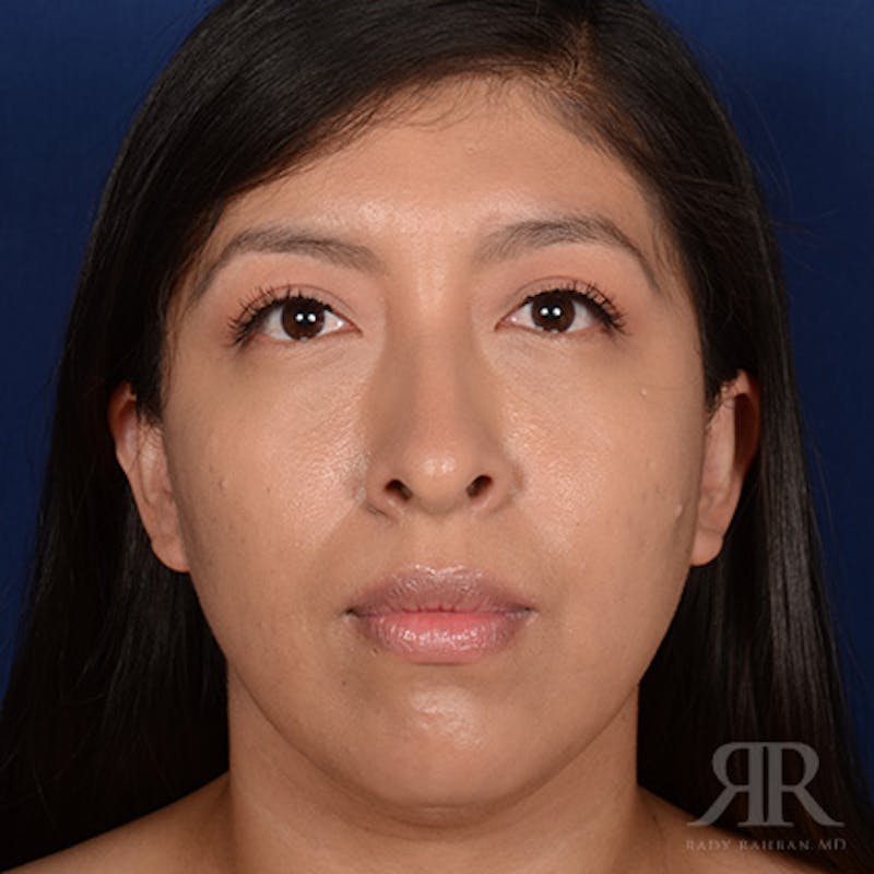 Female Rhinoplasty Before & After Gallery - Patient 419825 - Image 1
