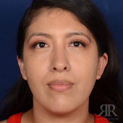 Female Rhinoplasty Before & After Gallery - Patient 419825 - Image 2