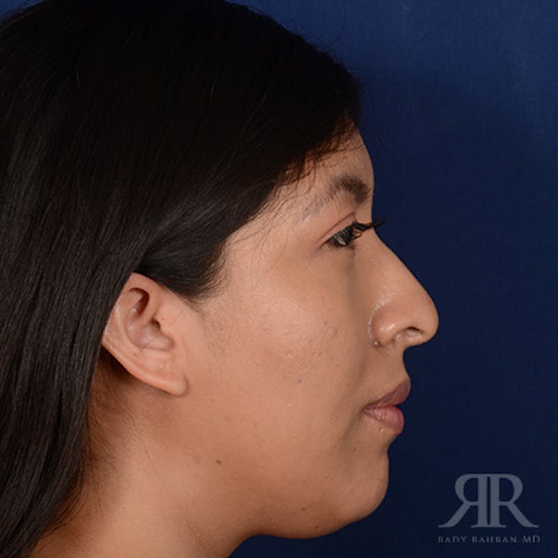 Female Rhinoplasty Before & After Gallery - Patient 419825 - Image 5