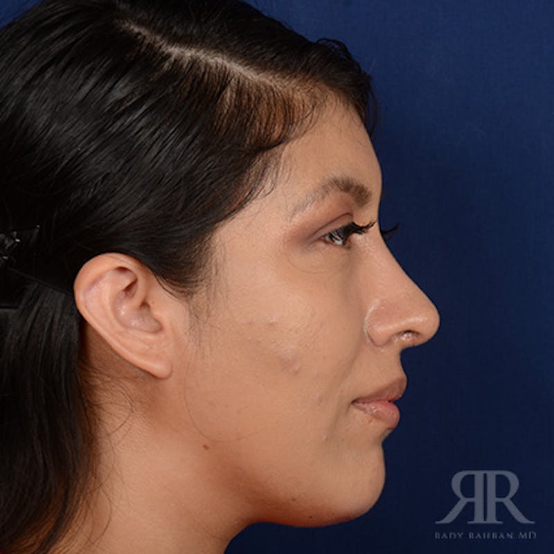 Female Rhinoplasty Before & After Gallery - Patient 419825 - Image 6