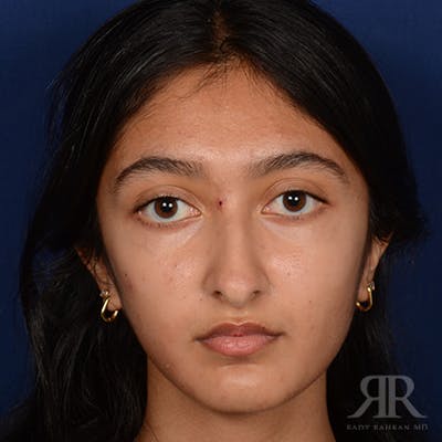 Female Rhinoplasty Before & After Gallery - Patient 176828 - Image 1