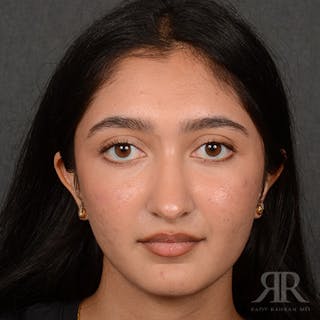 Female Rhinoplasty Before & After Gallery - Patient 176828 - Image 2