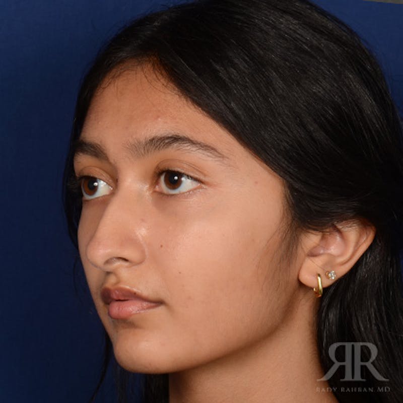 Female Rhinoplasty Before & After Gallery - Patient 176828 - Image 3