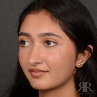 Female Rhinoplasty Before & After Gallery - Patient 176828 - Image 4