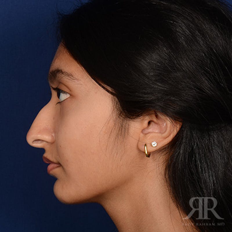 Female Rhinoplasty Before & After Gallery - Patient 176828 - Image 5