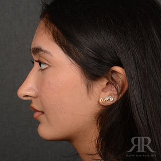 Female Rhinoplasty Before & After Gallery - Patient 176828 - Image 6