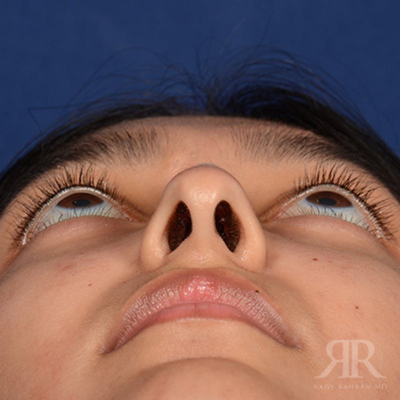 Female Rhinoplasty Before & After Gallery - Patient 176828 - Image 7