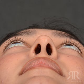 Female Rhinoplasty Before & After Gallery - Patient 176828 - Image 8