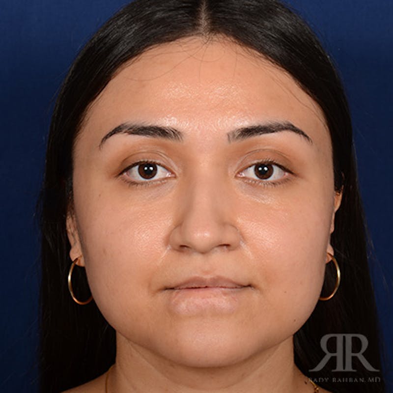 Female Rhinoplasty Before & After Gallery - Patient 198234 - Image 1