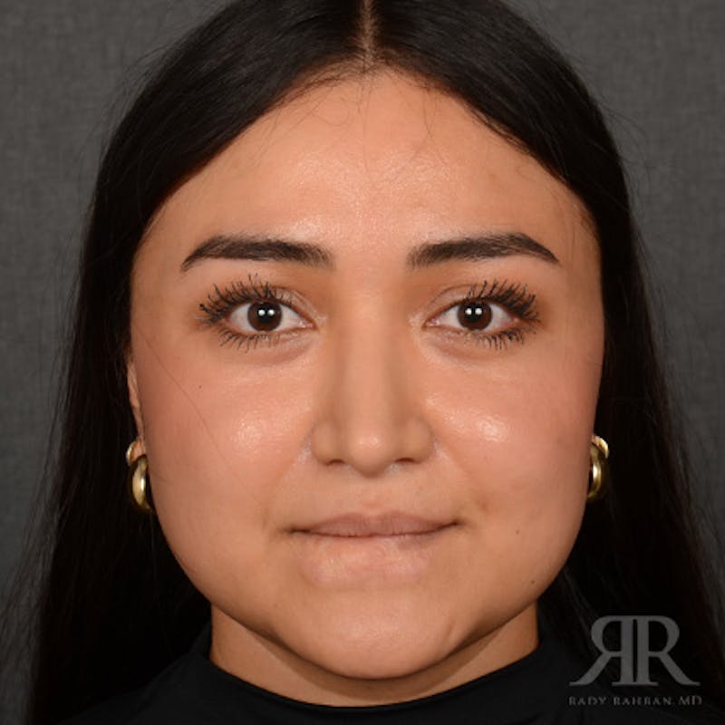 Female Rhinoplasty Before & After Gallery - Patient 198234 - Image 2