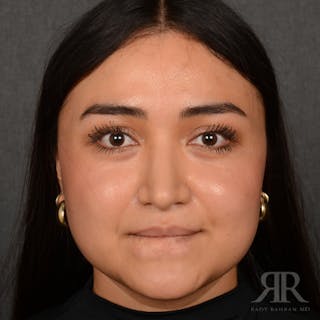 Female Rhinoplasty Before & After Gallery - Patient 198234 - Image 2