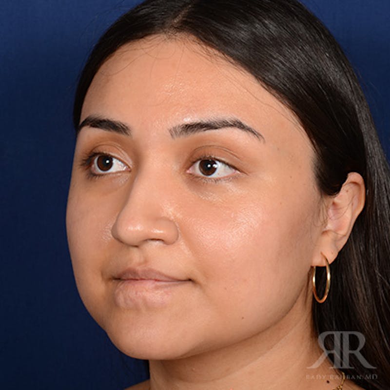 Female Rhinoplasty Before & After Gallery - Patient 198234 - Image 3