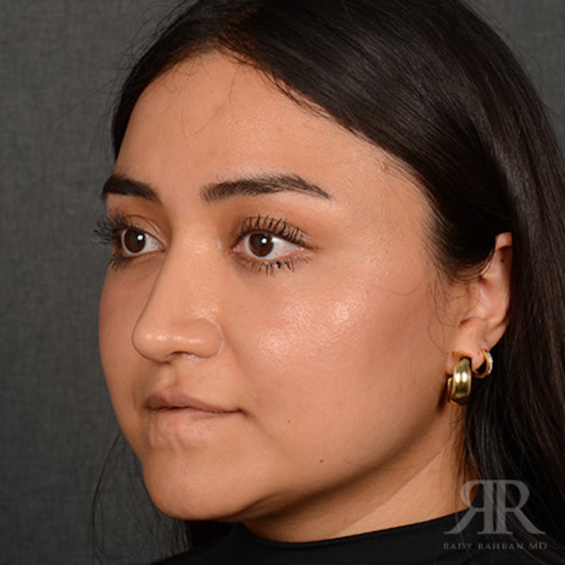 Female Rhinoplasty Before & After Gallery - Patient 198234 - Image 4