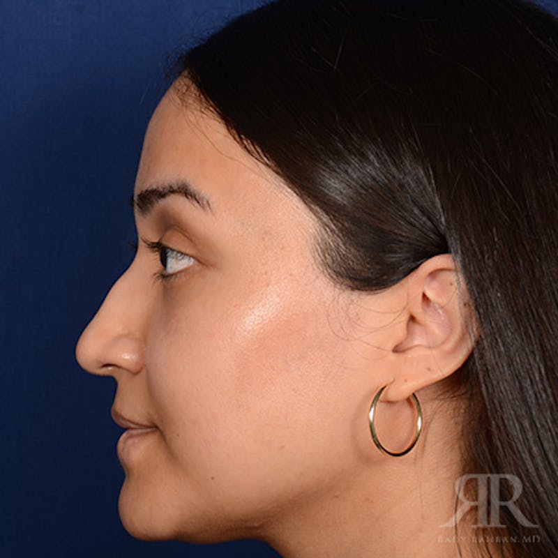 Female Rhinoplasty Before & After Gallery - Patient 198234 - Image 5