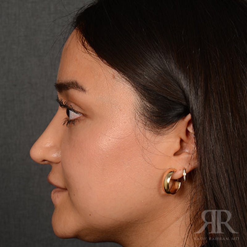 Female Rhinoplasty Before & After Gallery - Patient 198234 - Image 6