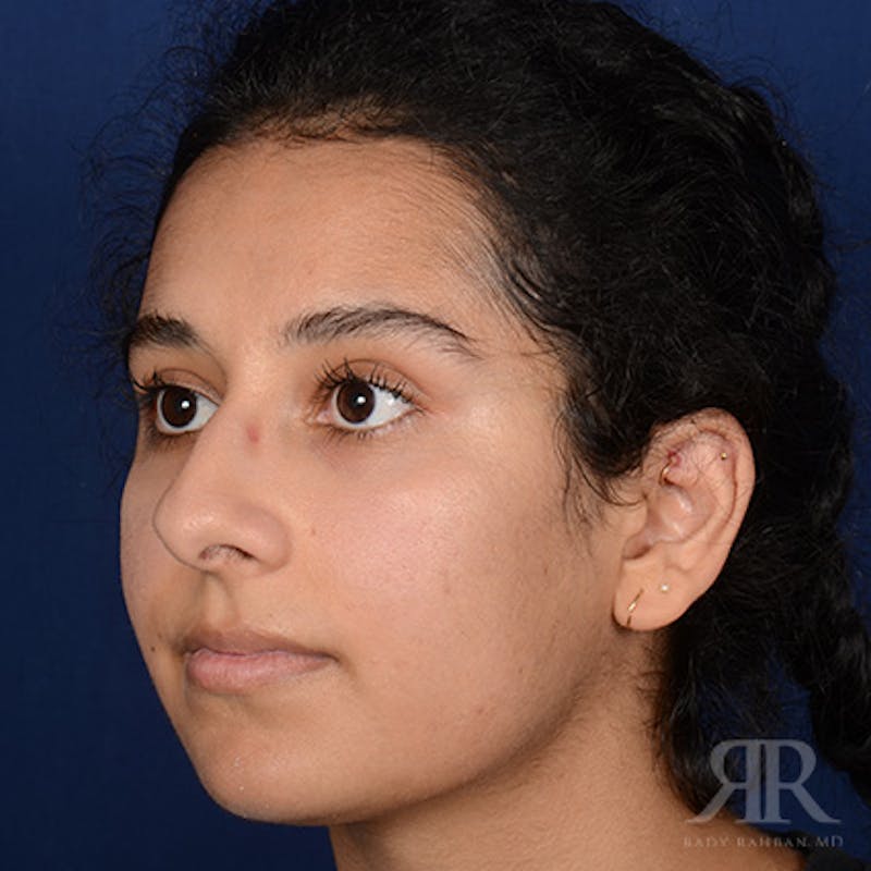 Female Rhinoplasty Before & After Gallery - Patient 130770 - Image 3