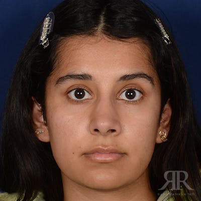 Female Rhinoplasty Before & After Gallery - Patient 130770 - Image 2