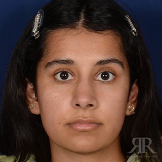 Female Rhinoplasty Before & After Gallery - Patient 130770 - Image 2