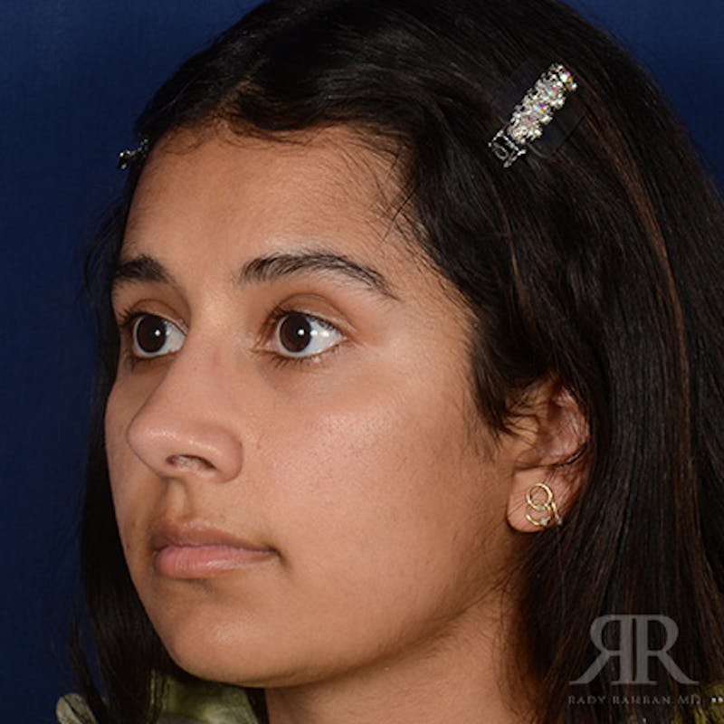 Female Rhinoplasty Before & After Gallery - Patient 130770 - Image 4
