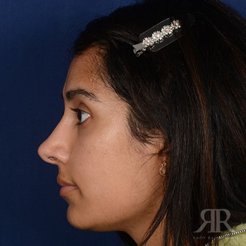 Female Rhinoplasty Before & After Gallery - Patient 130770 - Image 6