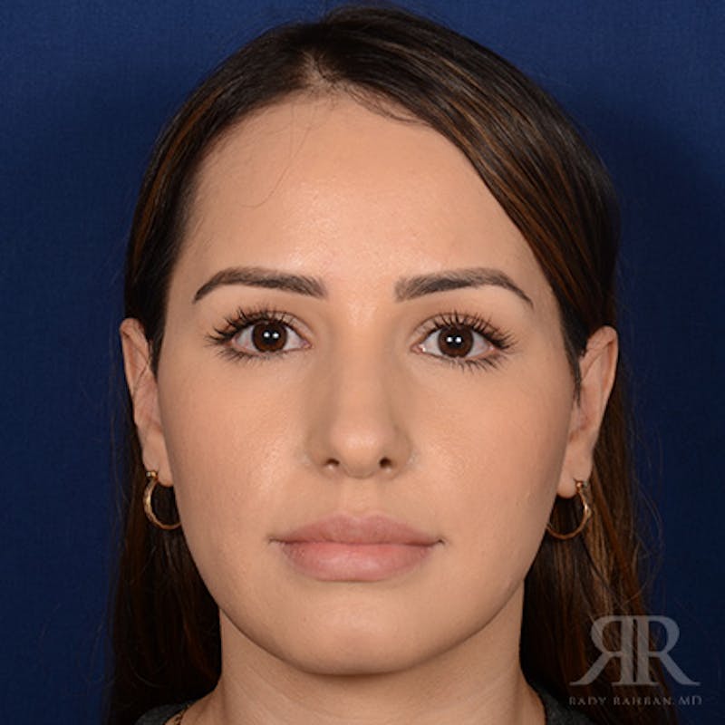 Female Rhinoplasty Before & After Gallery - Patient 972435 - Image 1