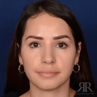 Female Rhinoplasty Before & After Gallery - Patient 972435 - Image 2
