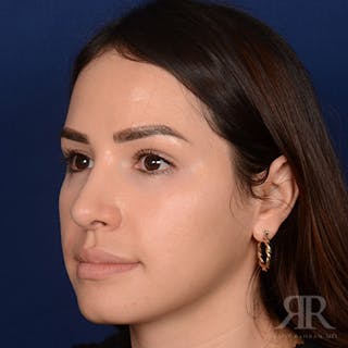 Female Rhinoplasty Before & After Gallery - Patient 972435 - Image 4