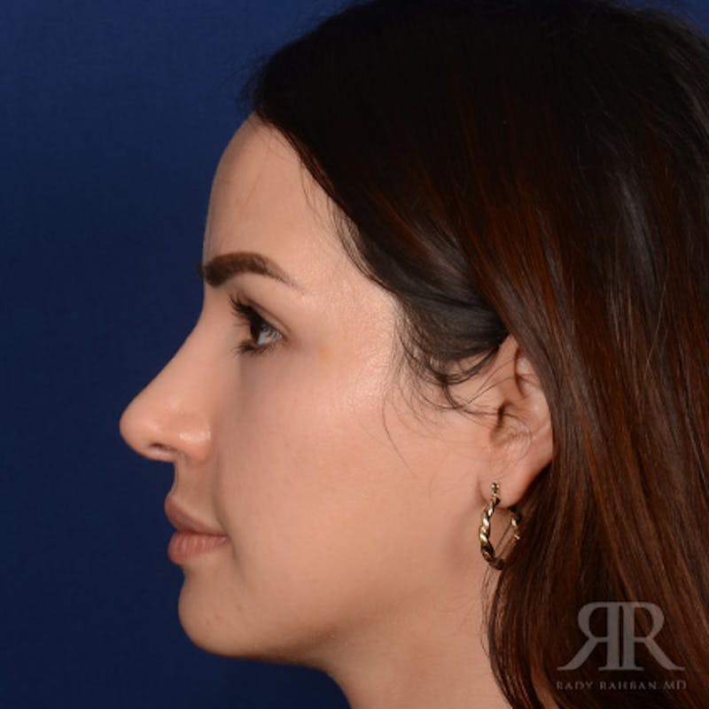 Female Rhinoplasty Before & After Gallery - Patient 972435 - Image 6