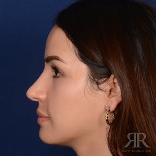Female Rhinoplasty Before & After Gallery - Patient 972435 - Image 6