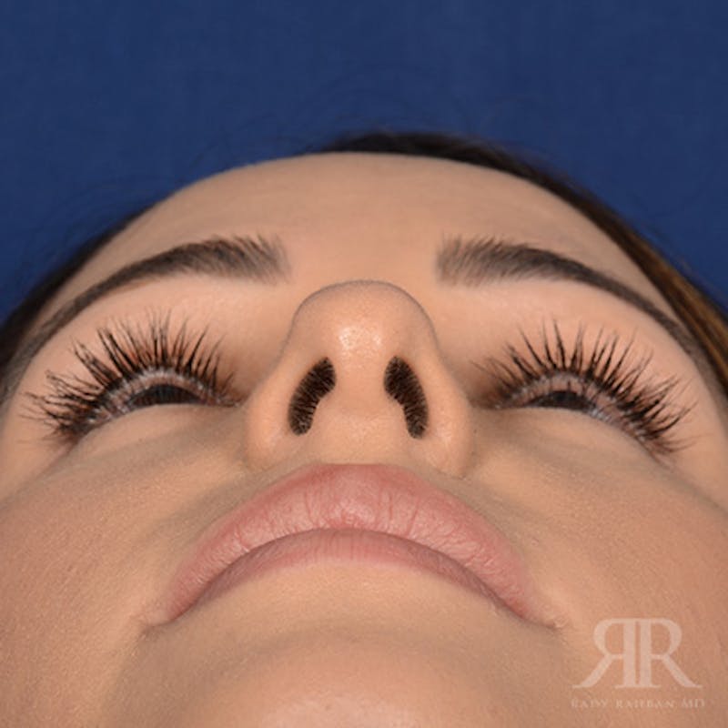 Female Rhinoplasty Before & After Gallery - Patient 972435 - Image 7