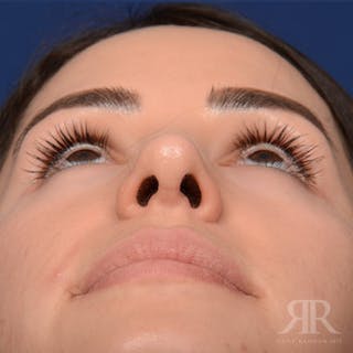 Female Rhinoplasty Before & After Gallery - Patient 972435 - Image 8